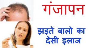 झड़ते हुए बालों को रोकने के उपाय - Balo Ka Jhadna Kaise Roke