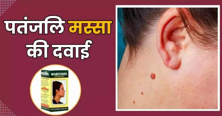 पतंजलि मस्सा की दवाई