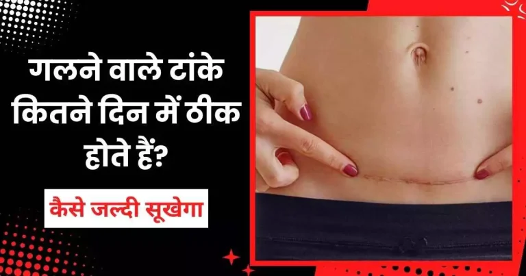गलने वाले टांके कितने दिन में ठीक होते हैं